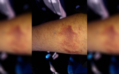 Mordió a un policía al resistir un arresto